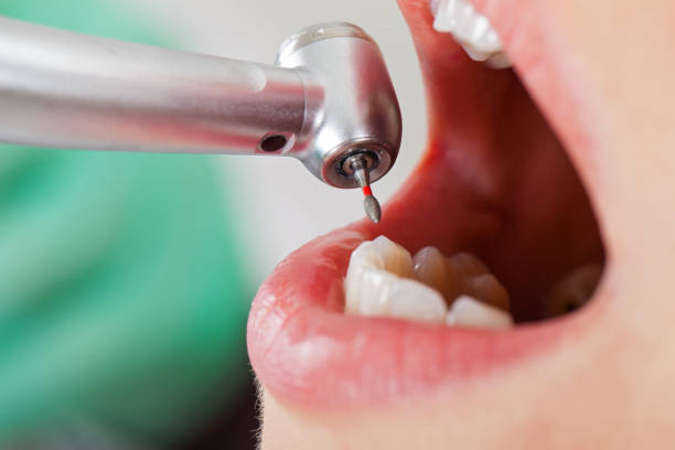 Best Emergency Dentist for Knocked-Out Tooth in Lake Dalecarlia, IN
